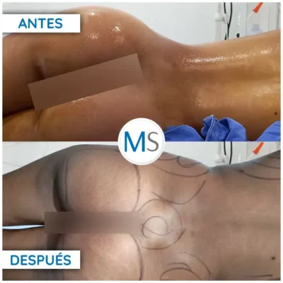 Img-DrMauricioSerrano-AntesDespues-Gluteoplastia-2