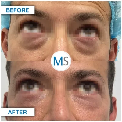 Img-DrMauricioSerrano-BeforeAfter-Blepharoplasty-2