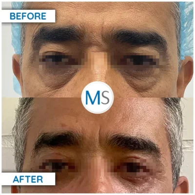 Img-DrMauricioSerrano-BeforeAfter-Blepharoplasty-3