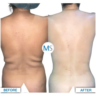 Img-DrMauricioSerrano-Antes&Despues-Liposculpture-EN-3