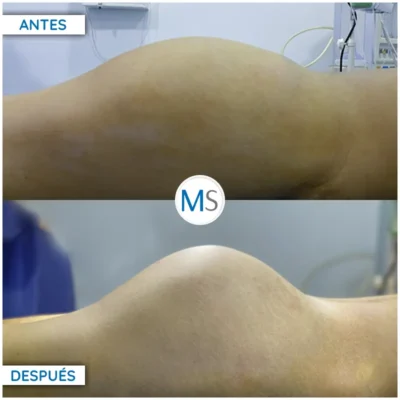 Img-DrMauricioSerrano-Antes_Despues-Gluteoplastia-HOR-1