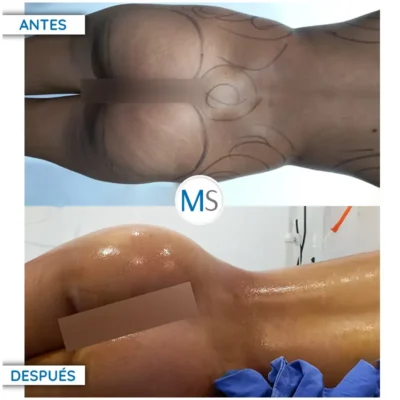 Img-DrMauricioSerrano-Antes_Despues-Gluteoplastia-HOR-2