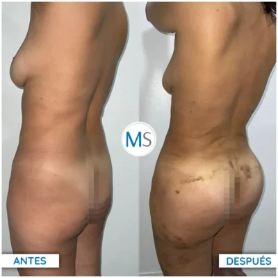 Img-DrMauricioSerrano-Antes_Despues-Gluteoplastia-VER-1