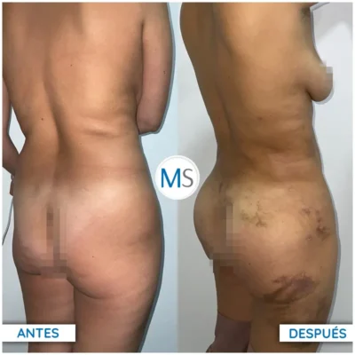 Img-DrMauricioSerrano-Antes_Despues-Gluteoplastia-VER-2