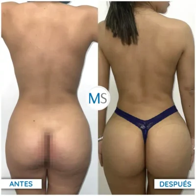 Img-DrMauricioSerrano-Antes_Despues-Liposuccion-1