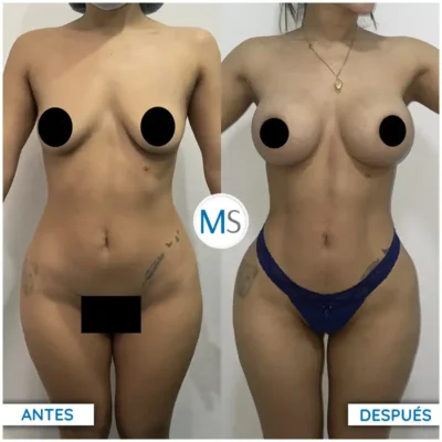 Img-DrMauricioSerrano-Antes_Despues-Liposuccion-5