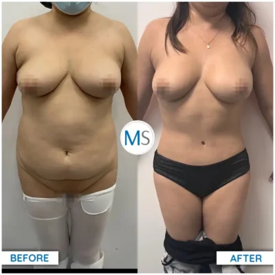 Img-DrMauricioSerrano-Before_After-Abdominoplasty-1