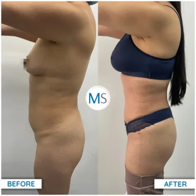 Img-DrMauricioSerrano-Before_After-Abdominoplasty-10