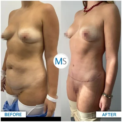 Img-DrMauricioSerrano-Before_After-Abdominoplasty-11