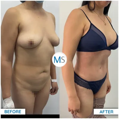 Img-DrMauricioSerrano-Before_After-Abdominoplasty-12