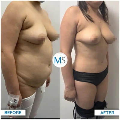 Img-DrMauricioSerrano-Before_After-Abdominoplasty-14