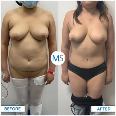 Img-DrMauricioSerrano-Before_After-Abdominoplasty-15