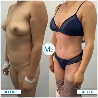 Img-DrMauricioSerrano-Before_After-Abdominoplasty-16