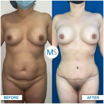 Img-DrMauricioSerrano-Before_After-Abdominoplasty-17