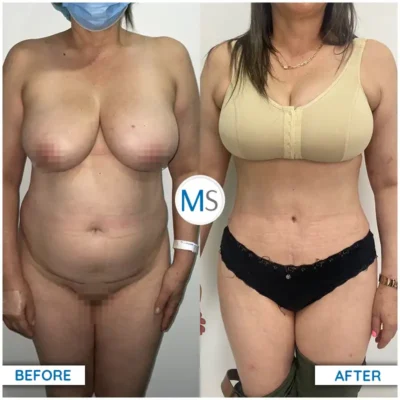 Img-DrMauricioSerrano-Before_After-Abdominoplasty-18