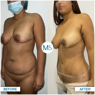 Img-DrMauricioSerrano-Before_After-Abdominoplasty-19