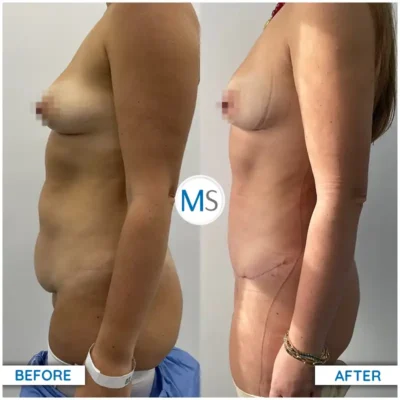 Img-DrMauricioSerrano-Before_After-Abdominoplasty-2