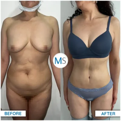 Img-DrMauricioSerrano-Before_After-Abdominoplasty-20