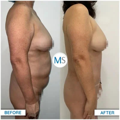 Img-DrMauricioSerrano-Before_After-Abdominoplasty-21