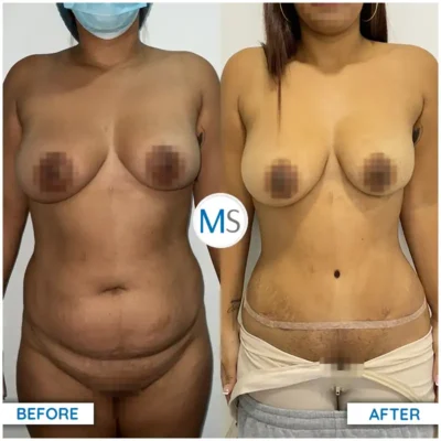 Img-DrMauricioSerrano-Before_After-Abdominoplasty-22