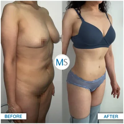 Img-DrMauricioSerrano-Before_After-Abdominoplasty-23