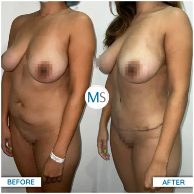 Img-DrMauricioSerrano-Before_After-Abdominoplasty-25