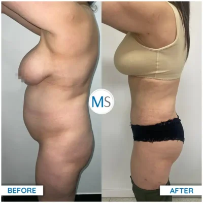 Img-DrMauricioSerrano-Before_After-Abdominoplasty-26