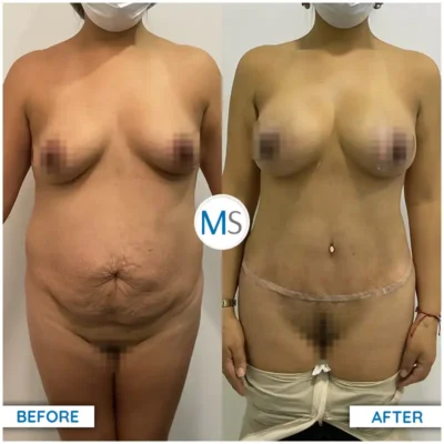 Img-DrMauricioSerrano-Before_After-Abdominoplasty-27