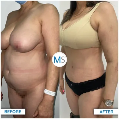 Img-DrMauricioSerrano-Before_After-Abdominoplasty-28