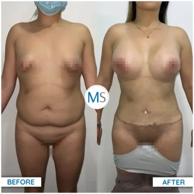 Img-DrMauricioSerrano-Before_After-Abdominoplasty-29