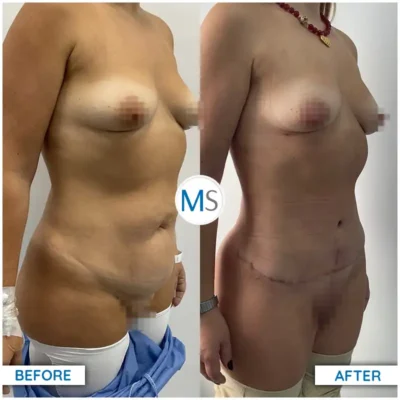 Img-DrMauricioSerrano-Before_After-Abdominoplasty-3