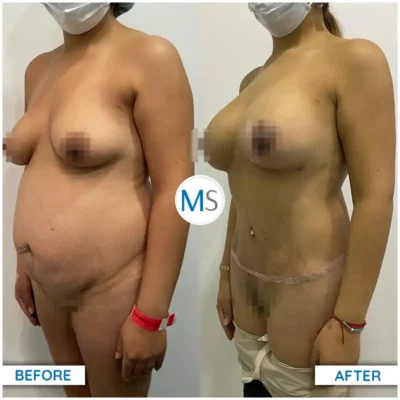 Img-DrMauricioSerrano-Before_After-Abdominoplasty-30