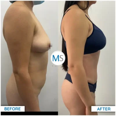 Img-DrMauricioSerrano-Before_After-Abdominoplasty-4