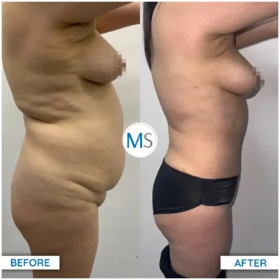 Img-DrMauricioSerrano-Before_After-Abdominoplasty-5