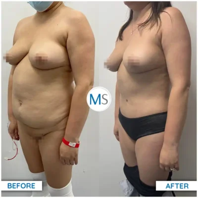 Img-DrMauricioSerrano-Before_After-Abdominoplasty-6