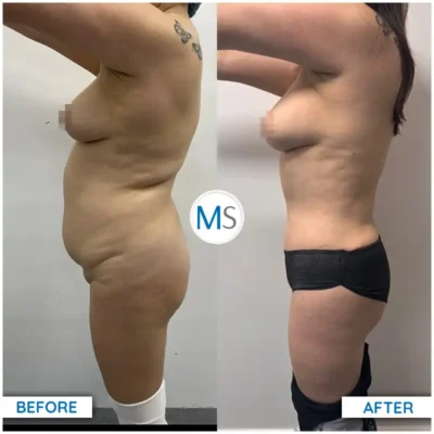 Img-DrMauricioSerrano-Before_After-Abdominoplasty-7