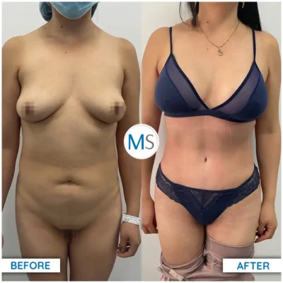 Img-DrMauricioSerrano-Before_After-Abdominoplasty-8