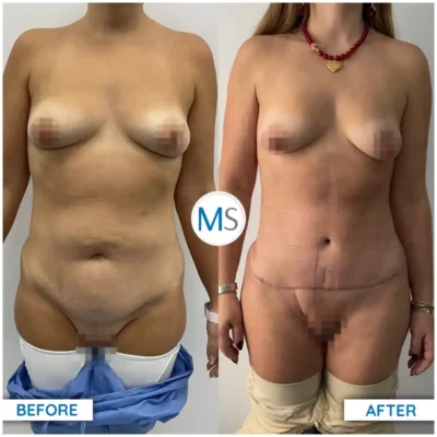 Img-DrMauricioSerrano-Before_After-Abdominoplasty-9