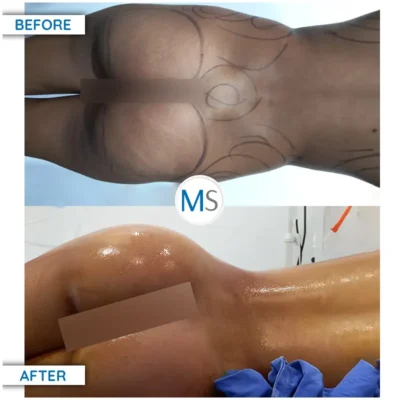 Img-DrMauricioSerrano-Before_After-Gluteoplasty-HOR-2