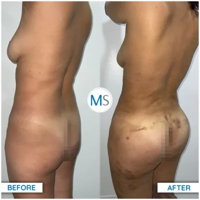 Img-DrMauricioSerrano-Before_After-Gluteoplasty-VER-1