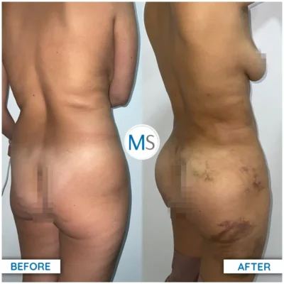 Img-DrMauricioSerrano-Before_After-Gluteoplasty-VER-2