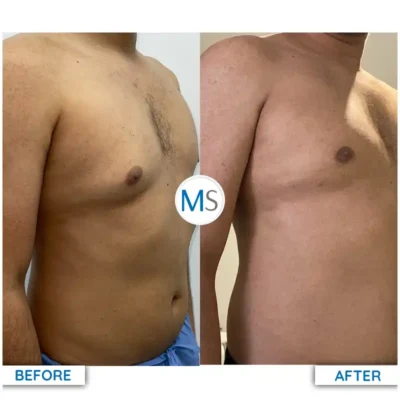 Img-DrMauricioSerrano-Before_After-Gynecomastia-1