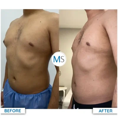 Img-DrMauricioSerrano-Before_After-Gynecomastia-3