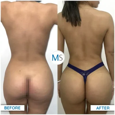 Img-DrMauricioSerrano-Before_After-Liposuction-1