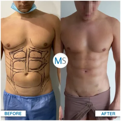 Img-DrMauricioSerrano-Before_After-Liposuction-2