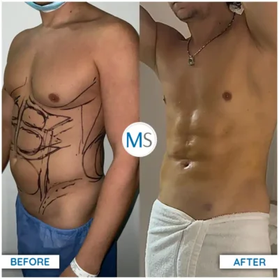 Img-DrMauricioSerrano-Before_After-Liposuction-3