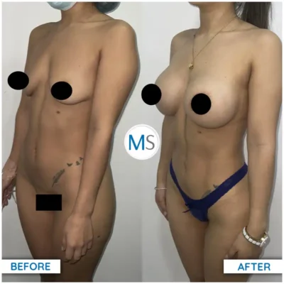 Img-DrMauricioSerrano-Before_After-Liposuction-4