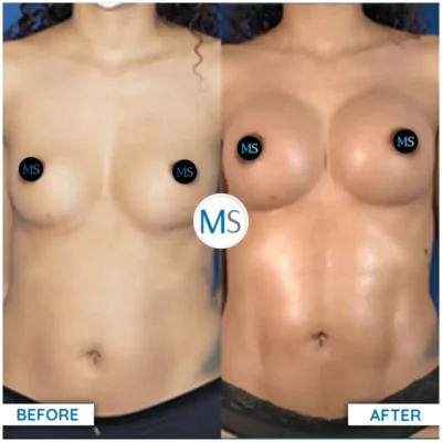 Img-DrMauricioSerrano-Before_After-Liposuction-6