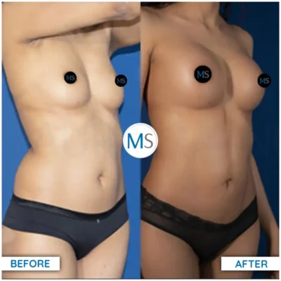 Img-DrMauricioSerrano-Before_After-Liposuction-7