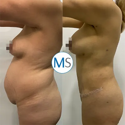 Img-DrMauricioSerrano-abdominoplastia-bogota-1-LCP